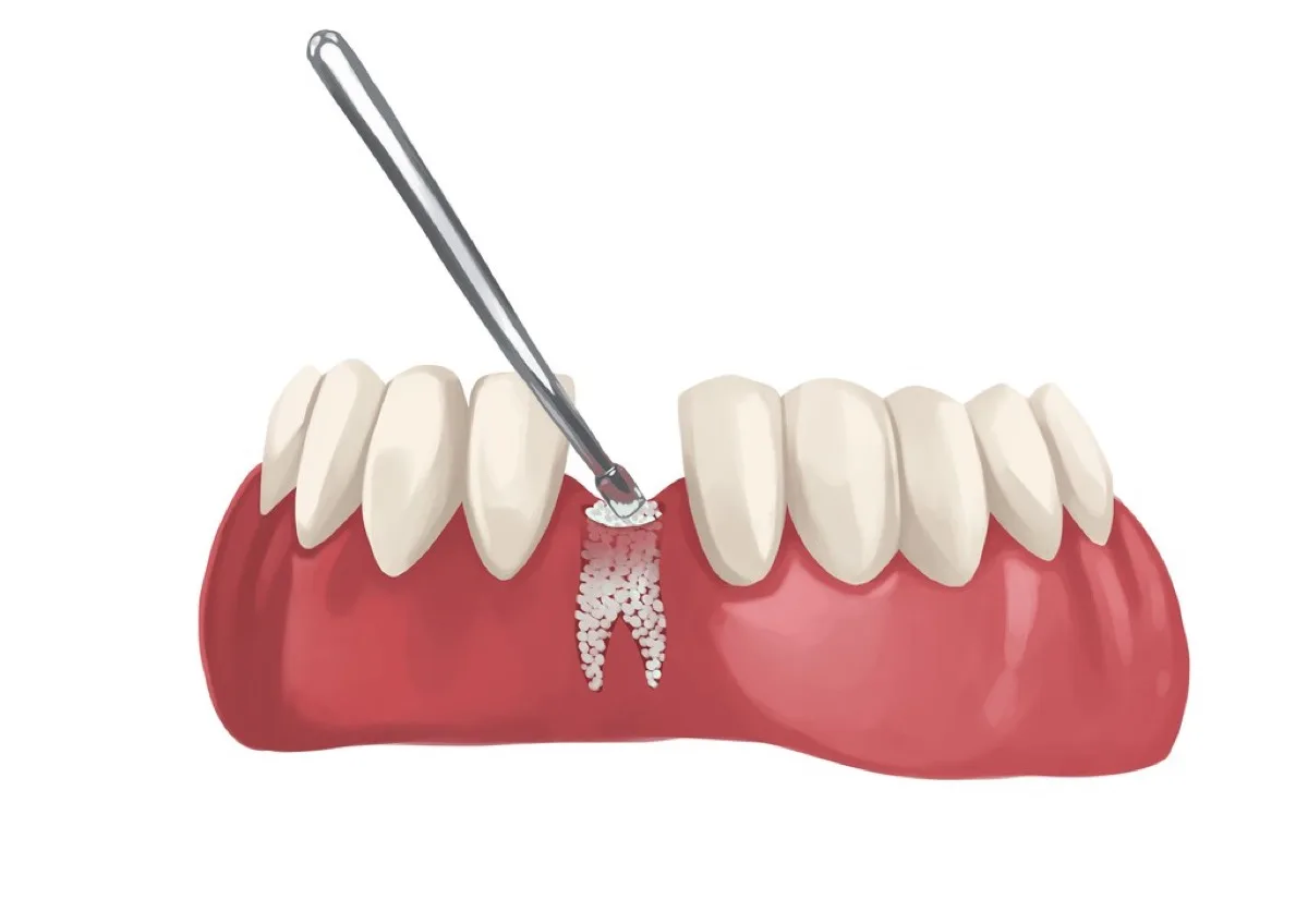 Illustration of bone graft material being placed in the jaw