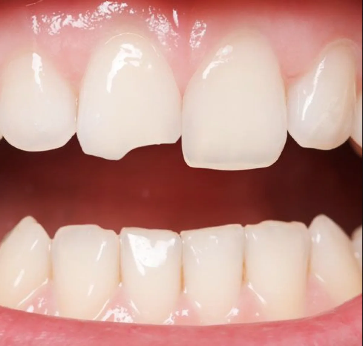 Close-up of a chipped front tooth before repair
