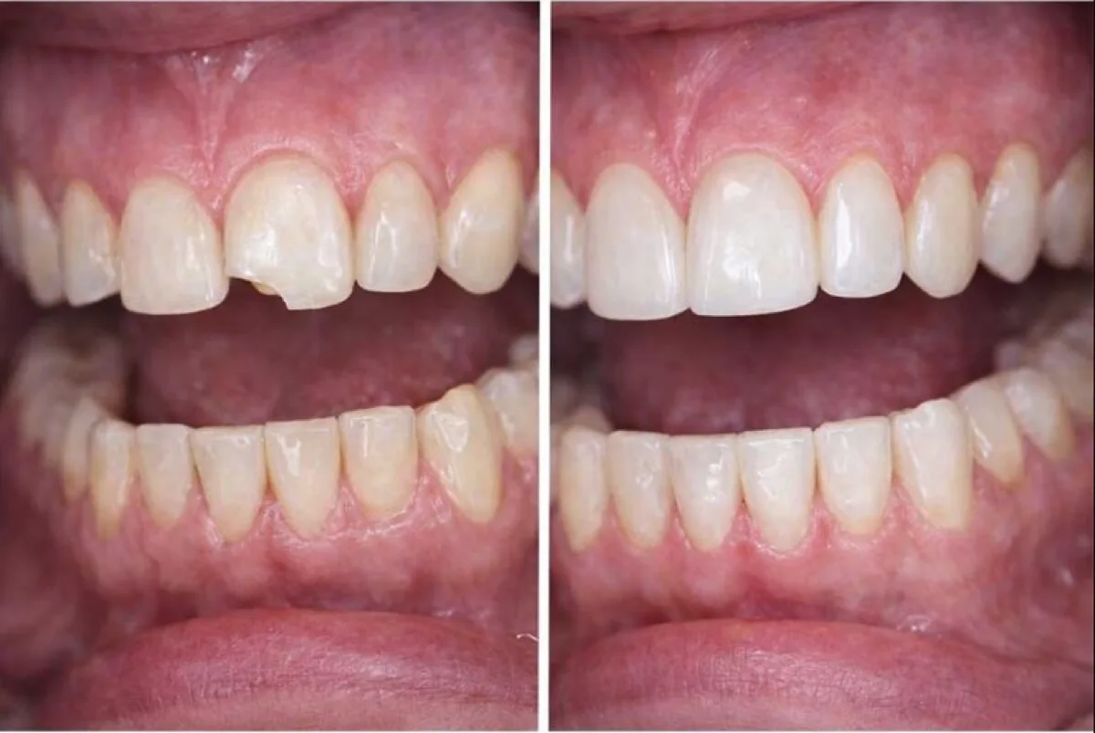 Before and after dental bonding repairing a chipped front tooth