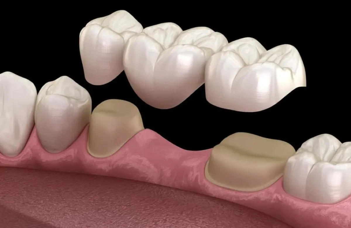 3D illustration of a dental bridge being placed over prepared anchor teeth