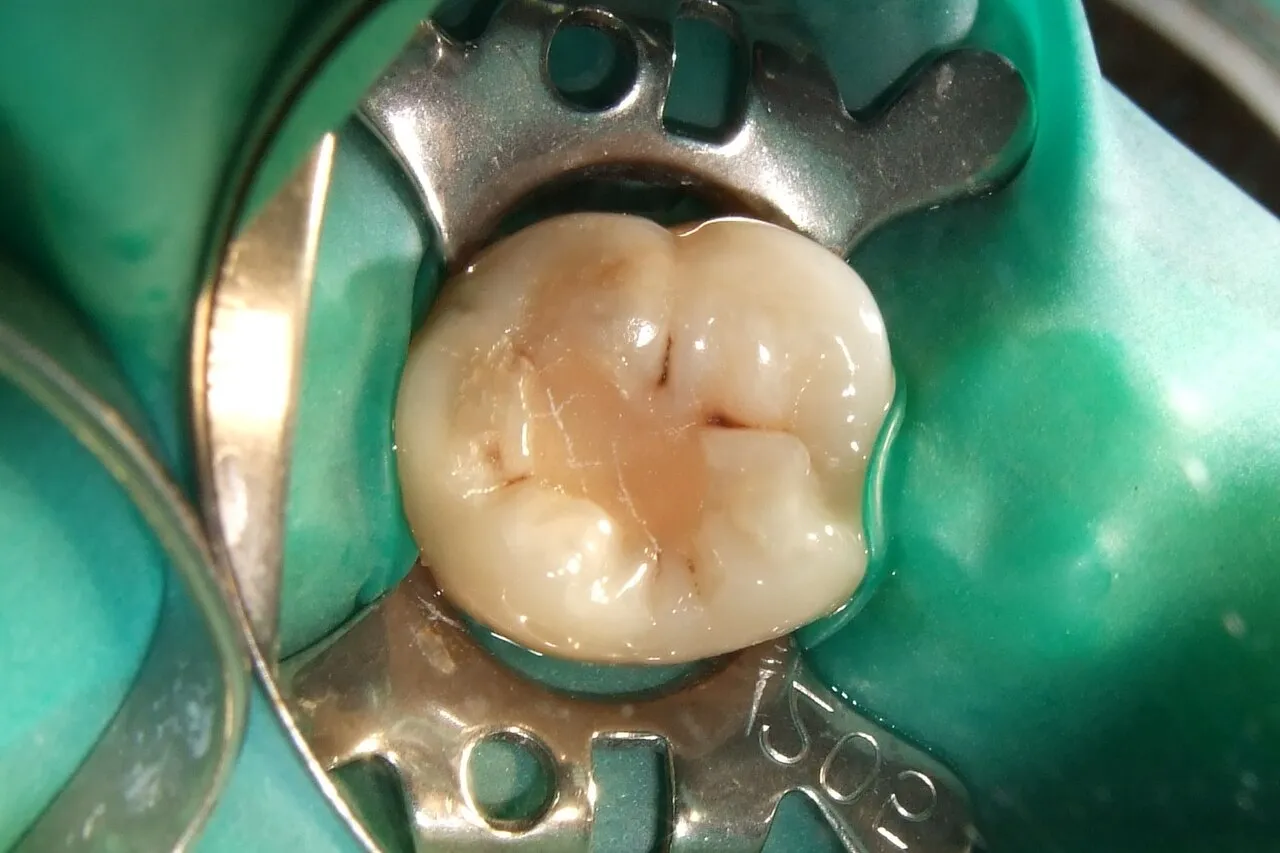 Tooth-colored composite filling placed in a molar