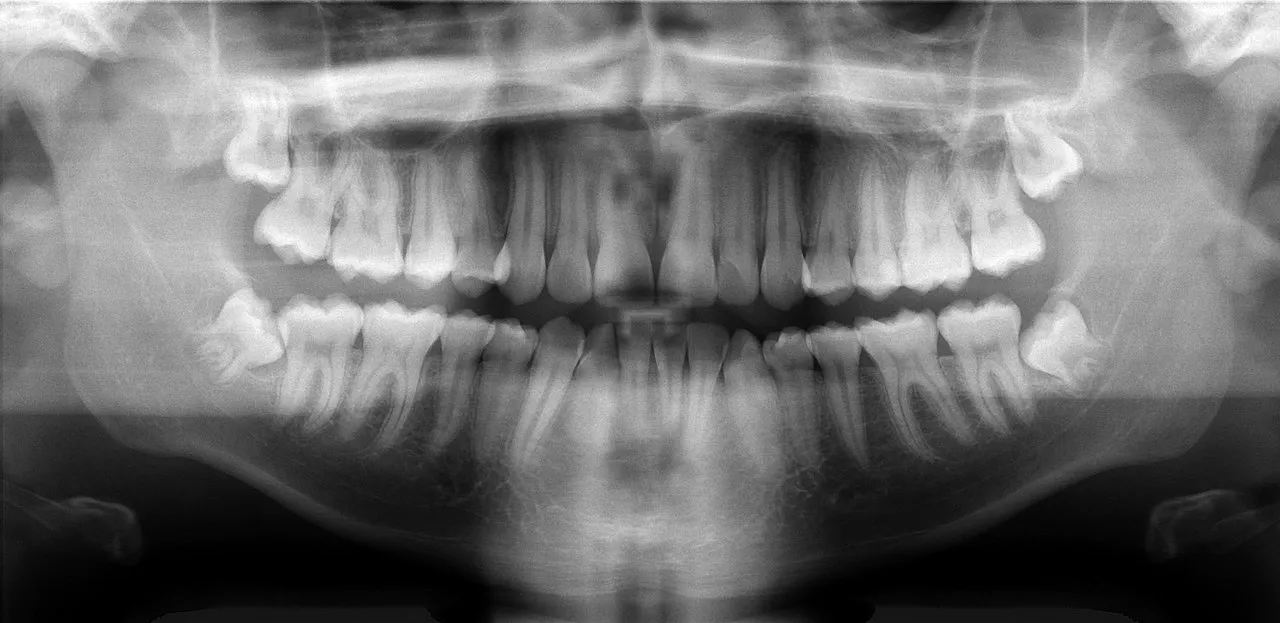 Panoramic digital dental X-ray showing a full set of teeth