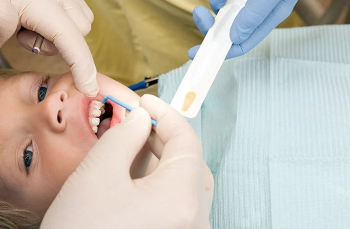 Child receiving a fluoride varnish treatment at the dentist