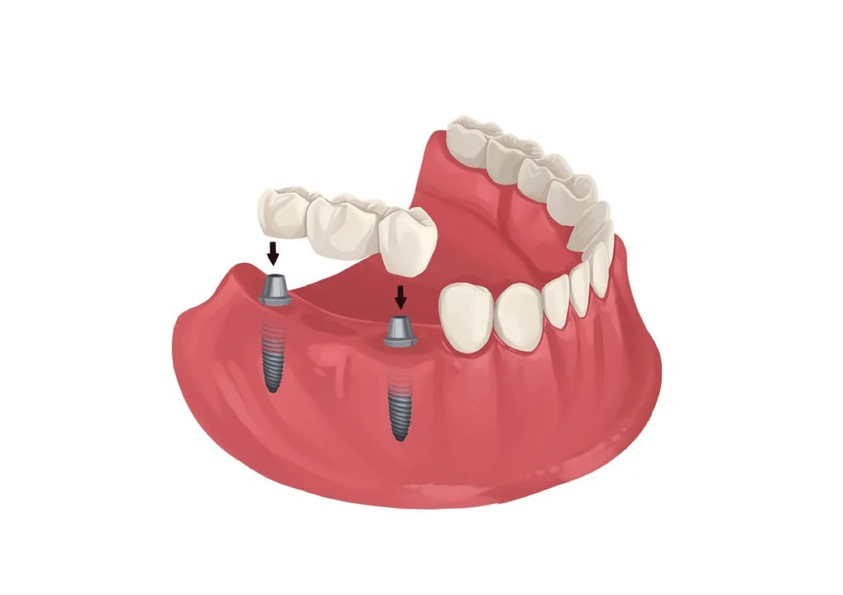 Illustration of an implant-supported bridge being placed on two dental implants