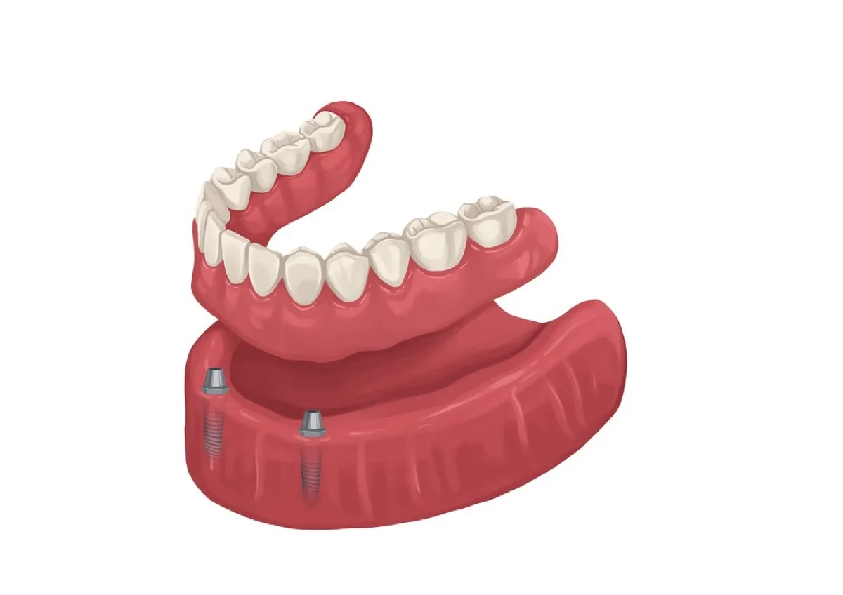 Illustration of an implant-supported denture attaching to dental implants