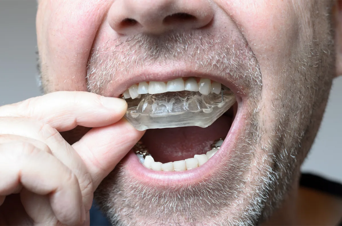 Man placing a custom-fitted nightguard over his teeth
