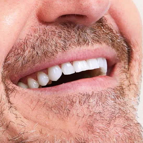 Porcelain veneers result - a real Fulton Family Dental patient's smile