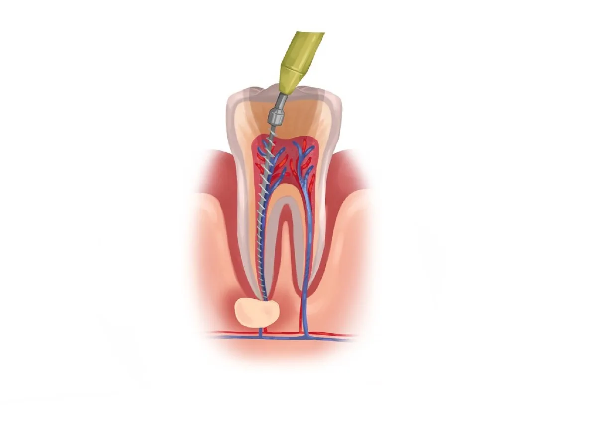 Illustration of root canal treatment cleaning the inside of a tooth