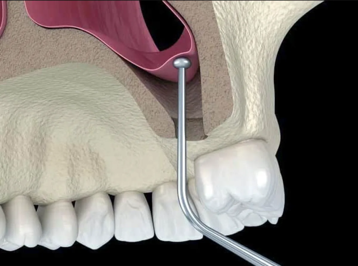 3D illustration of a sinus lift raising the sinus membrane above the upper molars