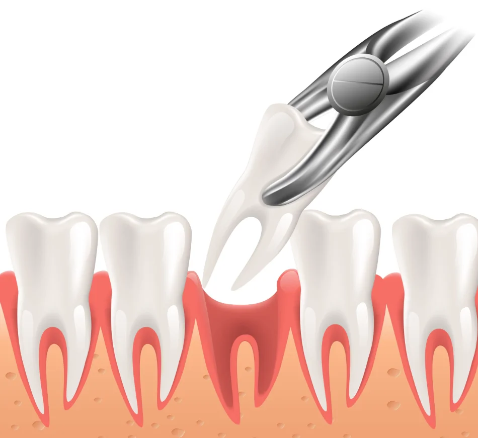 Illustration of a tooth being gently extracted with dental forceps