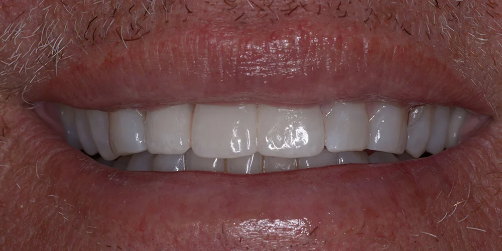 Porcelain Veneers patient after treatment at Fulton Family Dental