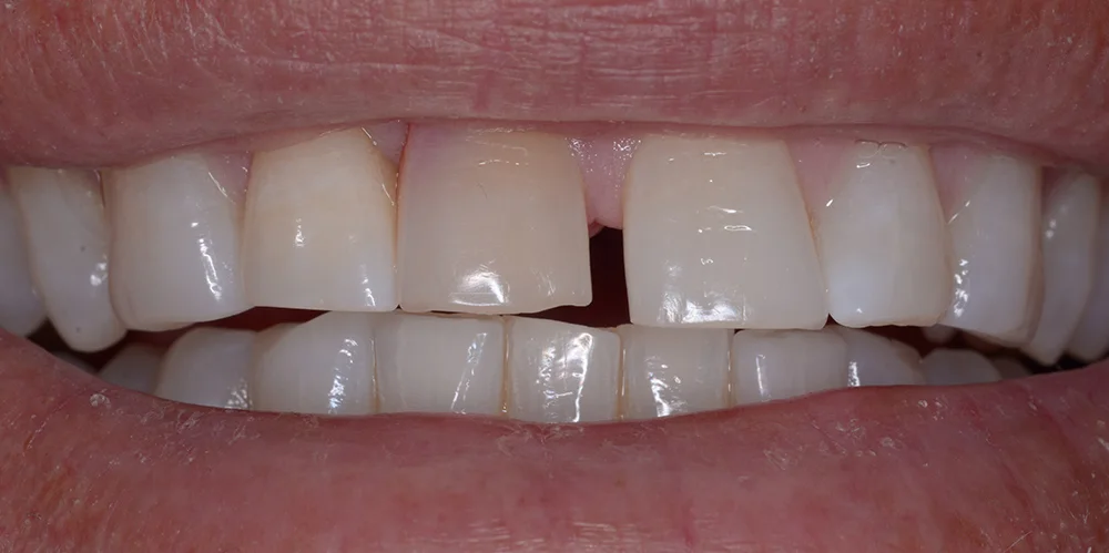 Porcelain Veneers patient before treatment at Fulton Family Dental