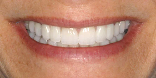 Porcelain Veneers patient after treatment at Fulton Family Dental