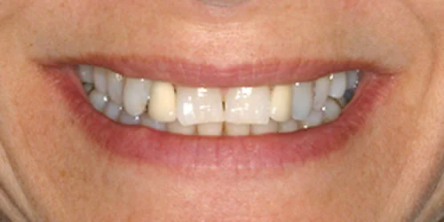 Porcelain Veneers patient before treatment at Fulton Family Dental