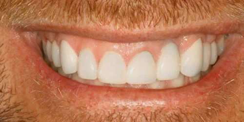Porcelain Veneers patient after treatment at Fulton Family Dental