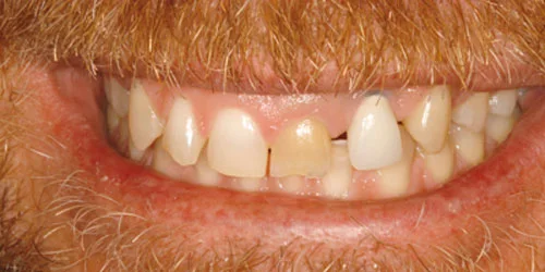 Porcelain Veneers patient before treatment at Fulton Family Dental