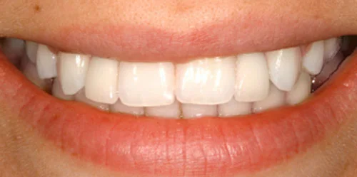 Dental Implants patient after treatment at Fulton Family Dental