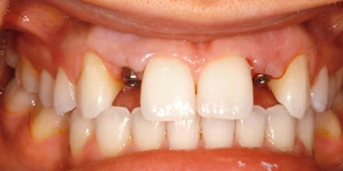 Dental Implants patient before treatment at Fulton Family Dental