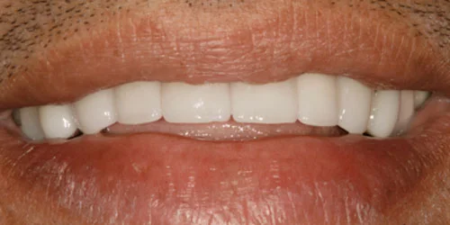Porcelain Veneers patient after treatment at Fulton Family Dental