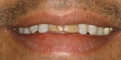 Porcelain Veneers patient before treatment at Fulton Family Dental