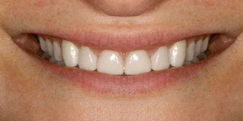 Porcelain Veneers patient after treatment at Fulton Family Dental