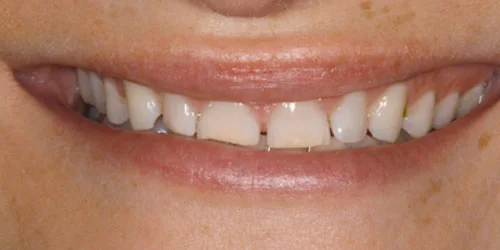 Porcelain Veneers patient before treatment at Fulton Family Dental