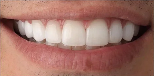 Porcelain Veneers patient after treatment at Fulton Family Dental