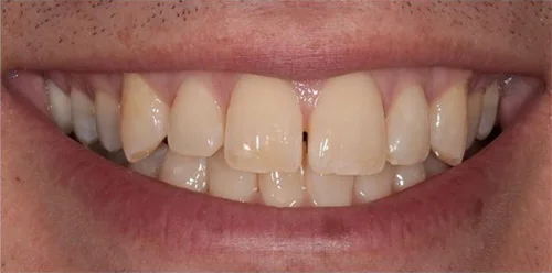 Porcelain Veneers patient before treatment at Fulton Family Dental
