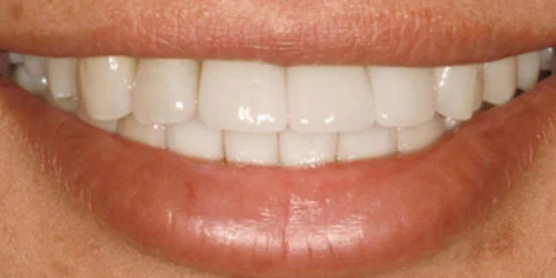 Dental Implants patient after treatment at Fulton Family Dental