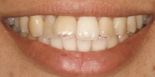 Dental Implants patient before treatment at Fulton Family Dental