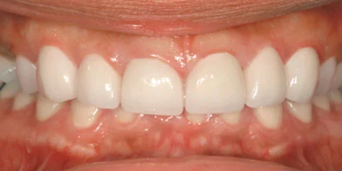 Porcelain Veneers patient after treatment at Fulton Family Dental