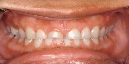 Porcelain Veneers patient before treatment at Fulton Family Dental
