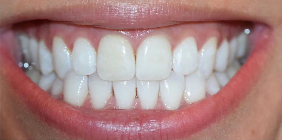 Teeth Whitening patient after treatment at Fulton Family Dental