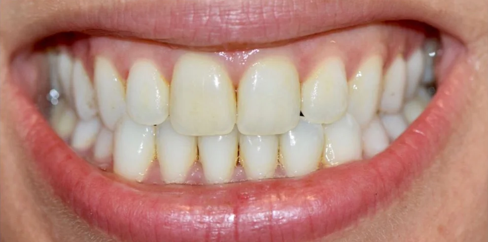 Teeth Whitening patient before treatment at Fulton Family Dental